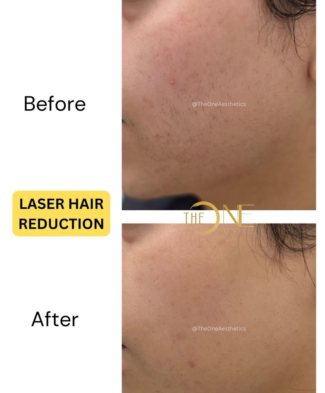 Laser Hair Reduction Results
